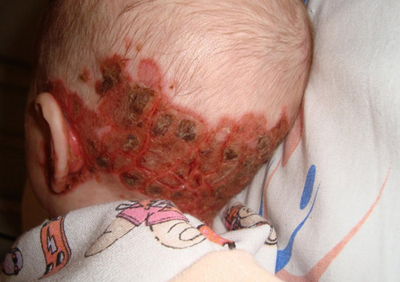 туберкулез кожи у ребенка