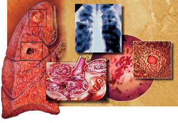 туберкулезные бактерии разрушают ткань легких
