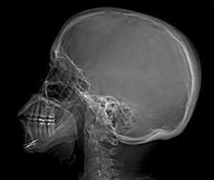 рентгенография черепа