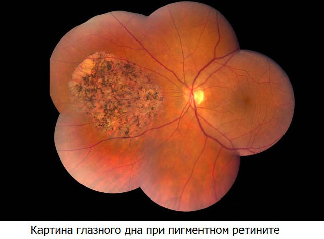 retinti-glaza