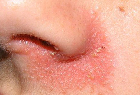 Себорейный дерматит на лице