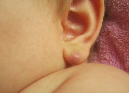 Атерома мочки уха у ребенка