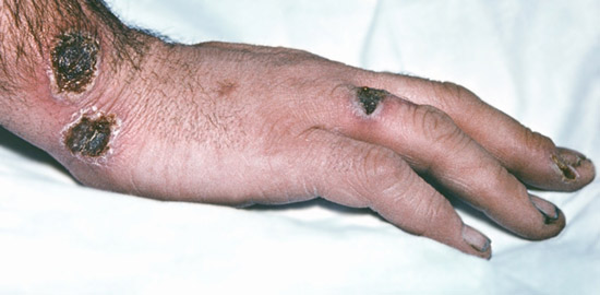 сибирская язва - карбункул на руке