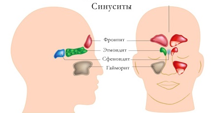Разновидности синусита