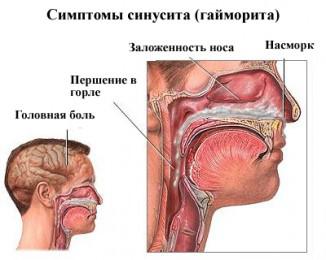 синусит носа симптомы
