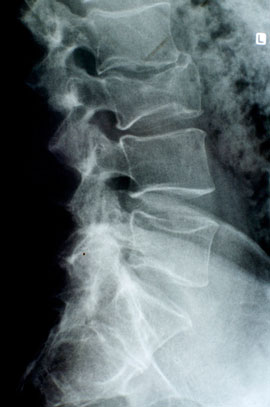 Сломанный поясничный позвонок на рентгене