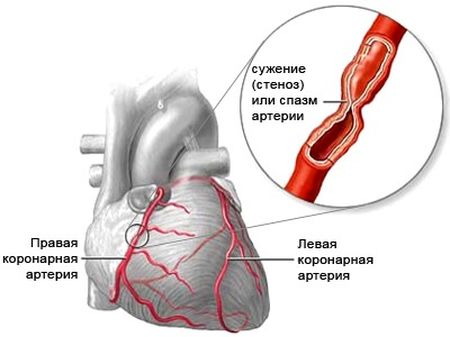 spazm-arterii