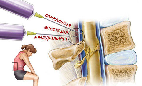 spinalnaja-epiduralnaja-e1425561671411