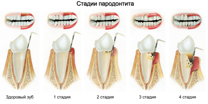 stadii-razvitiya-parodontita-min