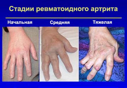 stadii-revmatoidnogo-artrita-paltsev-ruk