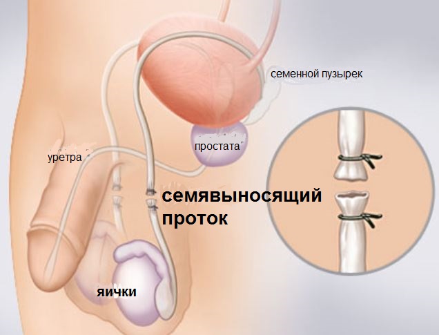 контрацепция методом вазэктомии