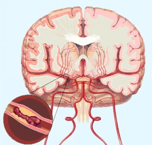 Головная боль - один из симптомов нарушения мозгового кровообращения