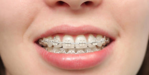 Ухаживать зубами во время ношения брекетов нужно с особой тщательностью, так как это влияет на результат