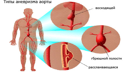Типы аневризма аорты