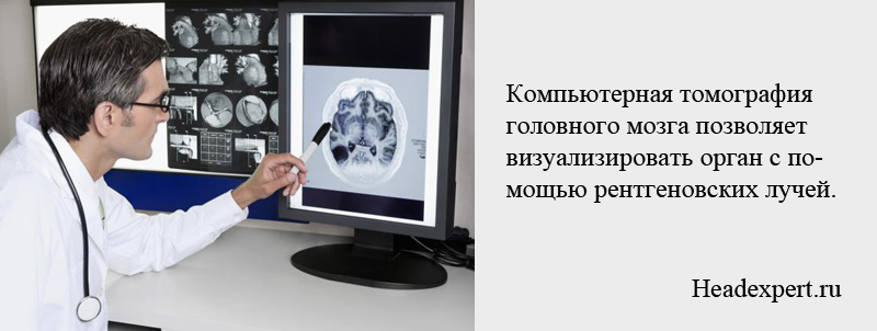 Компьютерная томография мозга позволяет диагностировать различные заболевания