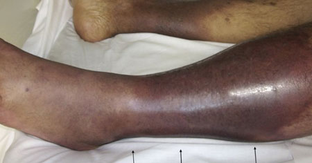 Лечение тромбофлебита ног