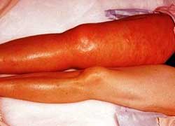 Осложнения тромбоза вен ног