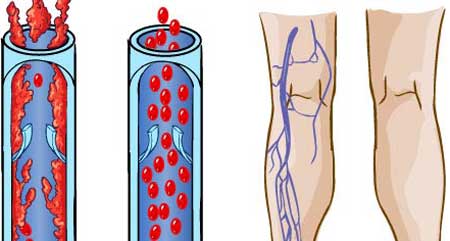 Симптомы тромбоза глубоких вен нижних конечностей