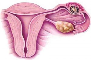 tubal-pregnancy