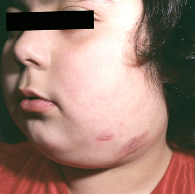 последствия туберкулеза у ребенка