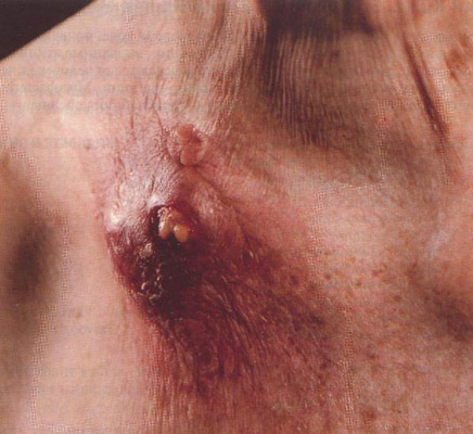 Туберкулез кожи колликвативный (скрофулодерма).