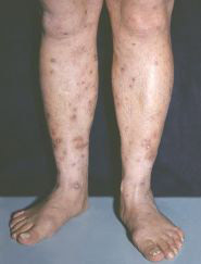 Папулонекротический туберкулез кожи голеней. 