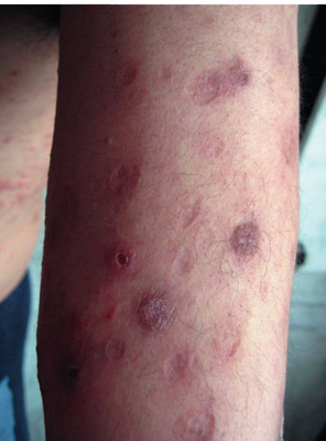 папулонекротический туберкулез кожи голеней.