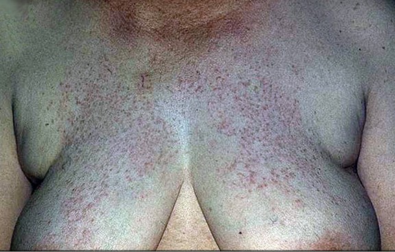 Лихеноидный туберкулез кожи.