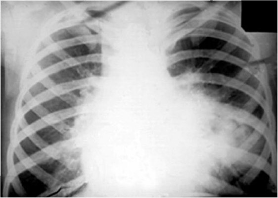 туберкулез внутригрудных лимфатических узлов