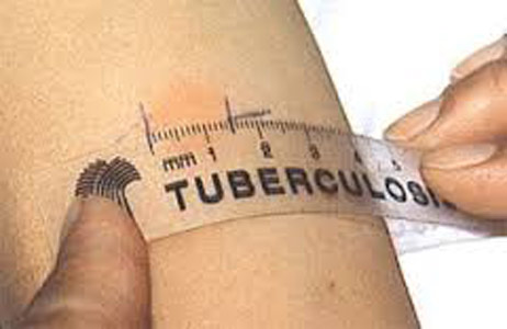 туберкулинодиагностика