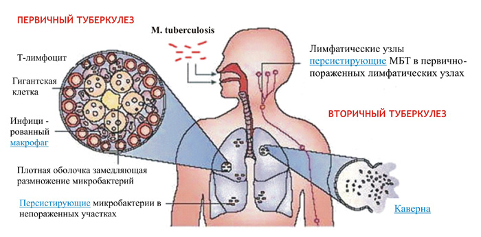 tuberkulez