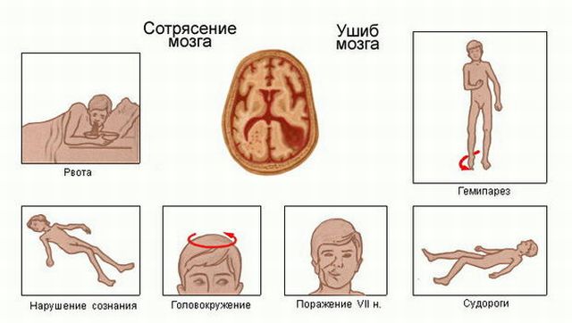 сотрясение и ушиб головного мозга