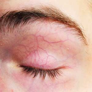 Появиться купероз может не только на лице, но и в зоне декольте или любом другом месте тела