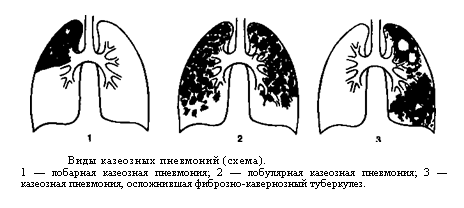 Казеозная пневмония.