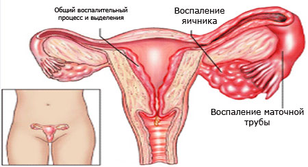 воспаление яичников у женщин 