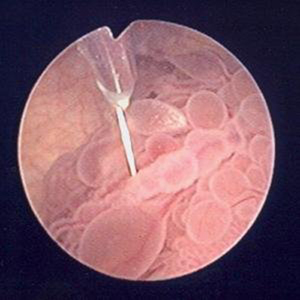папилломатоз мочевого пузыря