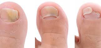 стадии грибка ногтей на ногах