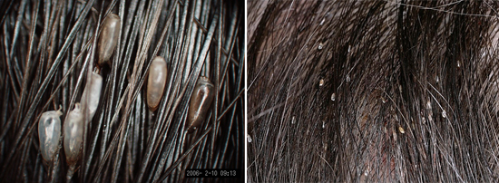 гниды на волосах (фото)