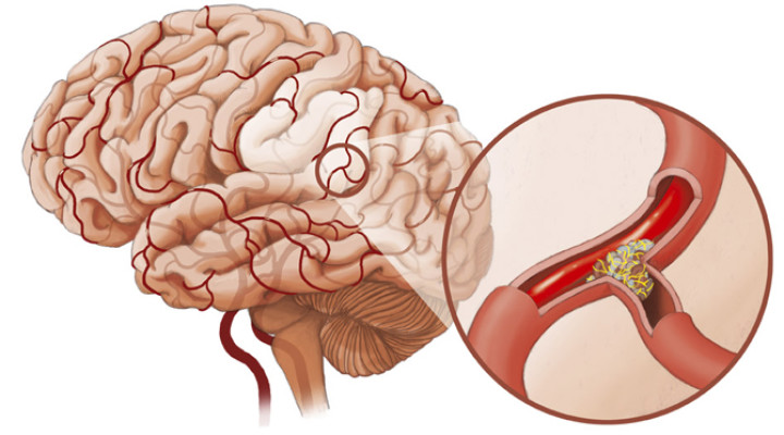 Спазм сосудов головного мозга: причины, симптомы, лечение
