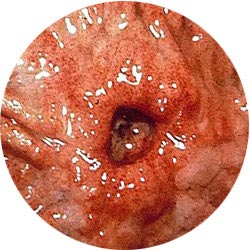 Изображение язвы желудка, полученное с помощью эндоскопа.